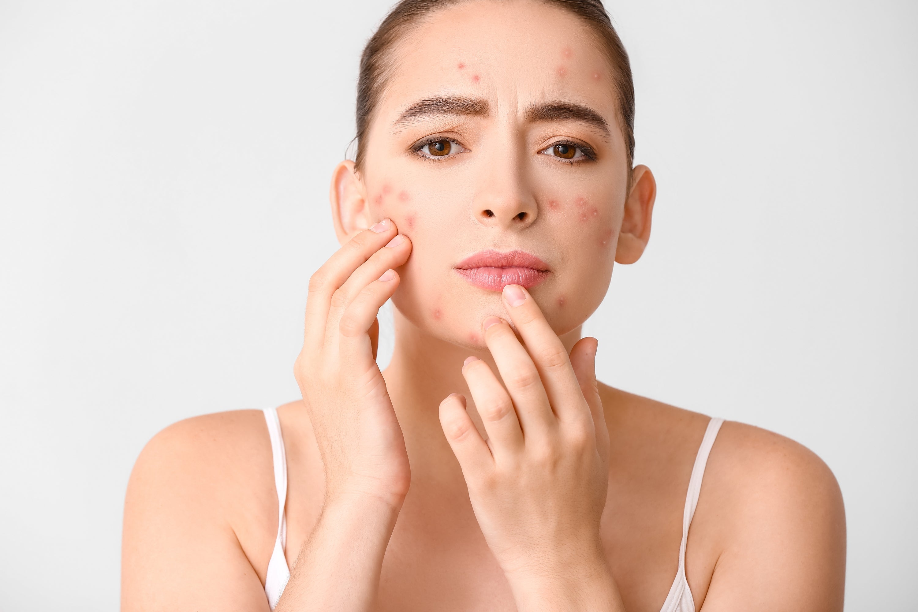 Woman with acne touching her face